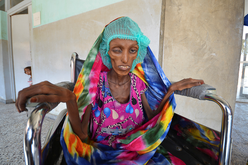 Saida Ahmad Baghili, 18, sits in a wheelchair at the al-Thawra hospital where she receives treatment for severe acute malnutrition in the Red Sea port city of Houdieda, Yemen. PHOTO: REUTERS
