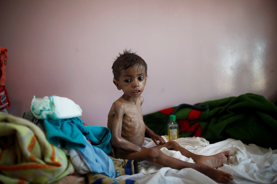 A malnourished boy sits on a bed at a malnutrition treatment center in Sanaa, Yemen. PHOTO: REUTERS