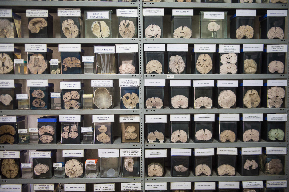 A collection of sick human brains is displayed at the 