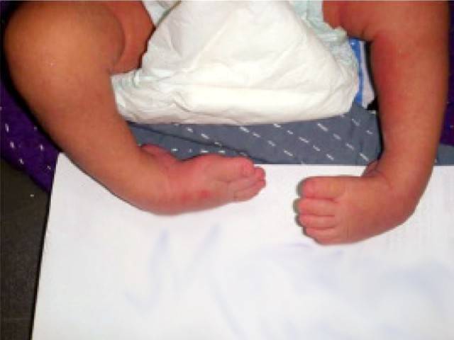 Seeking cure: ‘Every year, 8,000 babies are born with clubfeet in ...