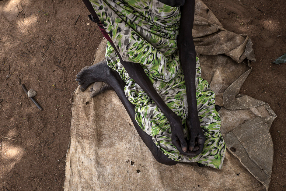 A cholera-stricken woman showing signs of malnutrition waits for treatment at a temporary field hospital near the remote village of Dor in the Awerial county in south-central Sudan. PHOTO: AFP