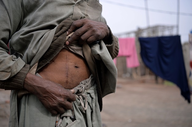Maqsood Ahmed, who sold one of his kidneys, displays a scar in Bhalwal in Sargodha District in Punjab. PHOTO: AFP