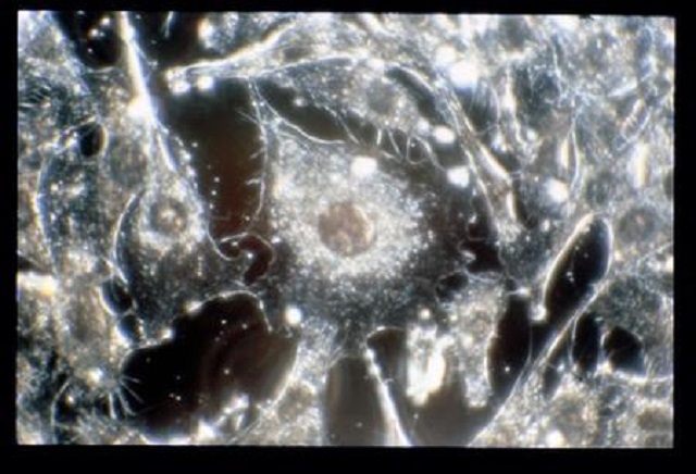 cancer cells are seen in this undated handout image photo reuters