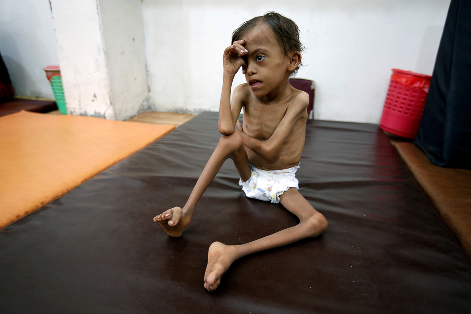Malnourished Marwan Ahmad Mahyoub, 10, sits at a special care centre where he receives rehabilitation exercises in the Red Sea port city of Hodeidah, Yemen. PHOTO: REUTERS