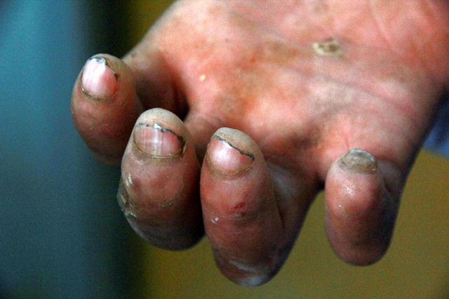 Leprosy patients suffer social stigma for their disease. PHOTO: ATHAR KHAN/EXPRESS
