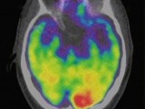 a-scan-of-a-brain-used-in-a-study-associates-the-brain-region-called-the-amygdala-an-area-linked-to-stress-to-greater-risk-of-heart-disease-and-stroke-is-seen-in-an-undated-image-released-by-the-lan-2