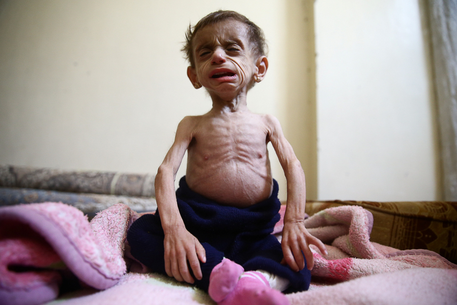 Two-and-a-half year old Hala al-Nufi, who suffers from a metabolic disorder which is worsening due to the siege and food shortages in the eastern Ghouta, reacts as she sits on a bed in the Saqba area, in the eastern Damascus, Syria. PHOTO: REUTERS