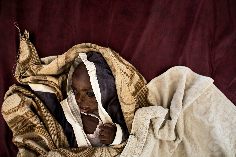 A severely malnourished child rest on her bed inside a feeding and rehabilitation centre in Tshikapa. PHOTO: AFP
