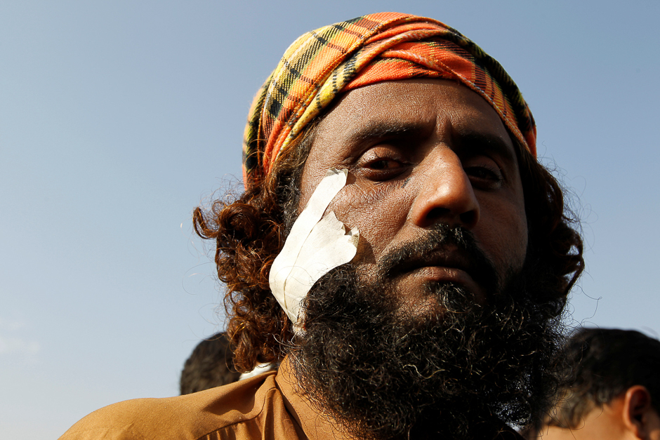 A supporter of the Tehrik-e-Labaik Pakistan Islamist political party injured during clashes with police poses for a portrait at their protest site at Faizabad junction in Islamabad, Pakistan. PHOTO: REUTERS