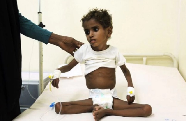 A malnourished Yemeni child receives treatment at a hospital in the Yemeni port city of Hodeidah. PHOTO: AFP