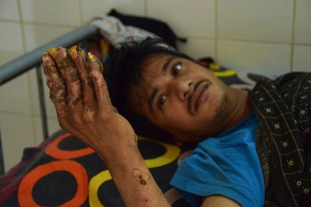 Twelve months after doctors declared him all but cured following 24 surgeries, Bajandar's hands are once again covered in the growths that characterise his rare condition. PHOTO:AFP