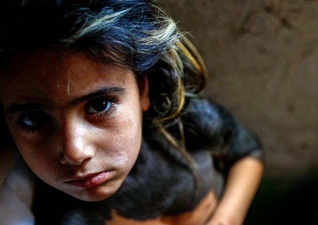 Haura, a four-year-old Iraqi child with a rare skin congenital disease that covers much of her upper body in black marks and hair, looks on as she sits in her family home in the village of Wahed Haziran, Diwaniya province, on April 17, 2018. PHOTO: AFP