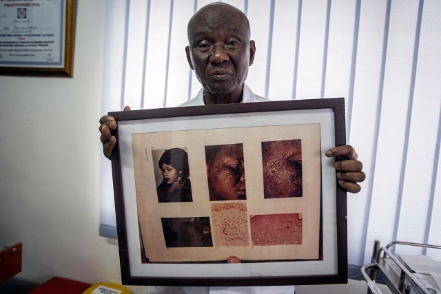 Edmund Delle, dermatologist and founder of Rabito Clinic, at his clinic in Accra on July 2, 2018. PHOTO: AFP