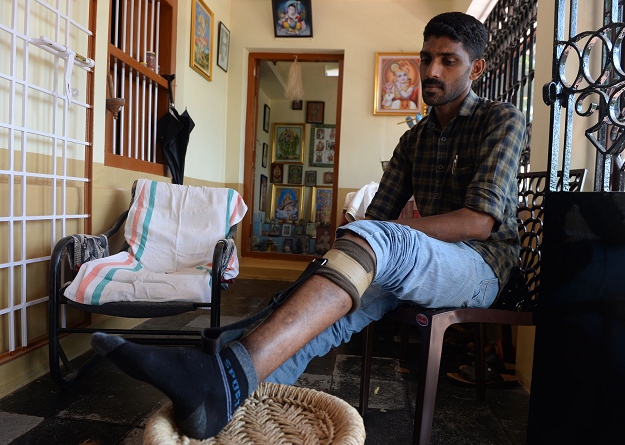 In this photo taken on April 20, 2019, Praveen K.K., 36, a member of the Rashtriya Swayamsevak Sangh (RSS) and a political attack victim, shows his leg that was injured in political violence, during an interview with AFP at Thalaserry in the southern Indian state of Kerala. PHOTO: AFP