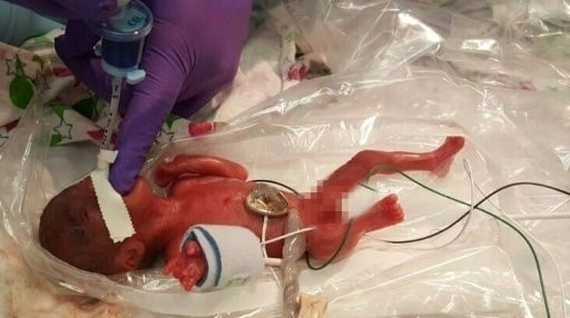 A picture received from Sharp Mary Birch Hospital for Women & Newborns shows baby Saybie, the world's smallest surviving newborn, when she was born in December 2018 in San Diego, California. PHOTO: AFP