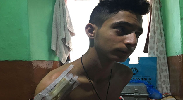 In this photo taken on September 6, 2019, Burhan Nazir Parrey, 16, sits with bandaging on his shoulder a month after he says he was shot with a pellet-firing shotgun by an Indian paramilitary soldier at point blank range in Srinagar. PHOTO: AFP 