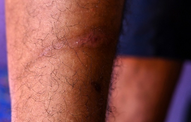 In this photograph, Abid Khan shows marks of torture on his leg. (Photo: AFP)