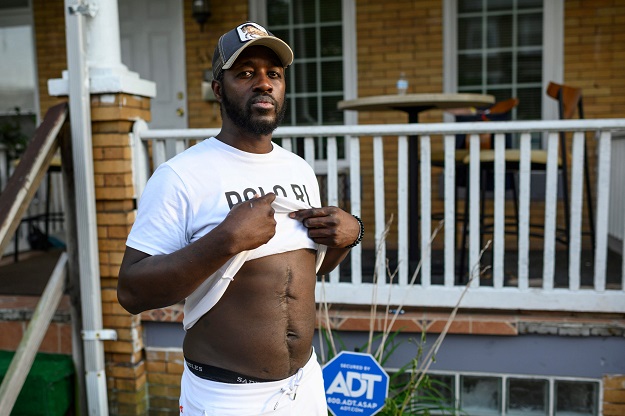 Baltimore resident and gunshot survivor Antonio Pinder, 31, shows his scars (Photo: AFP)