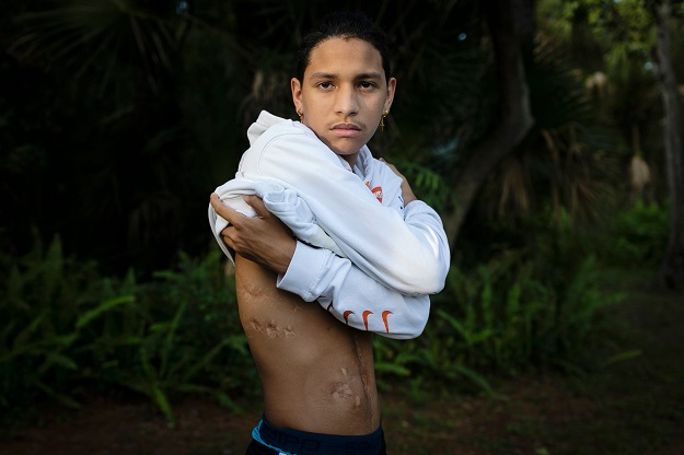 Anthony Borges shows his injuries during an interview with AFP (Photo: AFP)